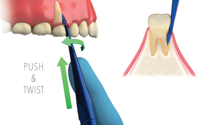 Atraumatic Extraction To Preserve The Alveolar Socket | TBS Dental